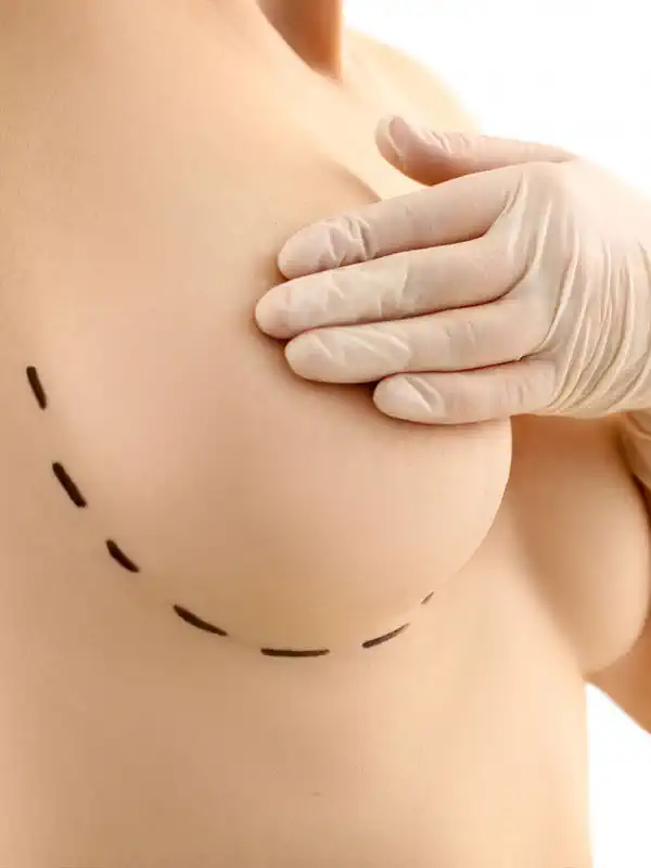Breast Lifting with Implants Breast Lifting with Implants